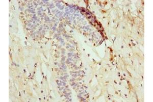 Immunohistochemistry of paraffin-embedded human breast cancer using ABIN7160728 at dilution of 1:100 (NANP antibody  (AA 1-248))