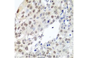 Immunohistochemistry of paraffin-embedded human lung cancer using PTTG1 antibody. (PTTG1 antibody)
