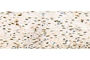 Immunohistochemistry of paraffin-embedded Human cervical cancer tissue using ABI2 Polyclonal Antibody at dilution of 1:45(x200) (ABI2 antibody)