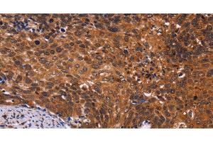 Immunohistochemistry of paraffin-embedded Human cervical cancer tissue using CDC5L Polyclonal Antibody at dilution 1:40 (CDC5L antibody)