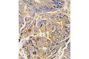 Formalin-fixed and paraffin-embedded human colon carcinoma tissue reacted with Autophagy G16L antibody , which was peroxidase-conjugated to the secondary antibody, followed by DAB staining. (ATG16L1 antibody  (AA 161-190))