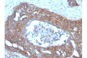 Formalin-fixed, paraffin-embedded human Ovarian Carcinoma stained with pS2 Mouse Monoclonal Antibody (GE2). (TFF1 antibody  (AA 57-84))