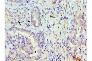 Immunohistochemistry of paraffin-embedded human lung cancer using ABIN7172874 at dilution of 1:100 (TRPM8 antibody  (AA 980-1104))