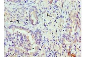 Immunohistochemistry of paraffin-embedded human lung cancer using ABIN7172874 at dilution of 1:100