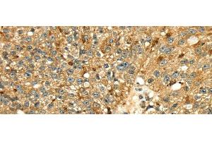 Immunohistochemistry of paraffin-embedded Human breast cancer tissue using Cathepsin H Polyclonal Antibody at dilution 1:50 (Cathepsin H antibody)