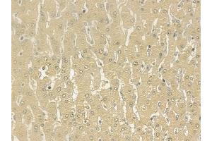 ABIN6261313 and ABIN6277179 at 1/100 staining human hepatocellular carcinoma by IHC-P. (DLGAP5 antibody  (N-Term))