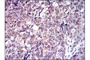Immunohistochemical analysis of paraffin-embedded bladder cancer tissues using SLC2A4 mouse mAb with DAB staining.