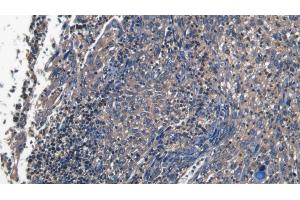 Detection of PECAM1 in Human Endometrial cancer Tissue using Polyclonal Antibody to Platelet/Endothelial Cell Adhesion Molecule (PECAM1) (CD31 antibody  (AA 199-287))