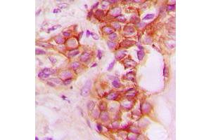 Immunohistochemical analysis of CD40 staining in human breast cancer formalin fixed paraffin embedded tissue section. (CD40 antibody  (C-Term))