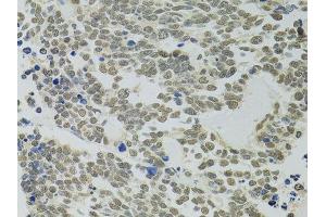 Immunohistochemistry of paraffin-embedded human lung cancer using PPP4C antibody.
