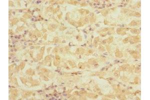 Immunohistochemistry of paraffin-embedded human gastric cancer using ABIN7149799 at dilution of 1:100 (DET1 antibody  (AA 15-240))