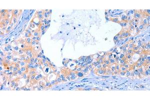Immunohistochemistry of paraffin-embedded Human cervical cancer tissue using ARRB1 Polyclonal Antibody at dilution 1:50 (beta Arrestin 1 antibody)