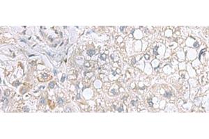 Immunohistochemistry of paraffin-embedded Human liver cancer tissue using STK32A Polyclonal Antibody at dilution of 1:95(x200) (STK32A antibody)