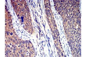 Immunohistochemical analysis of paraffin-embedded cervical cancer tissues using HTR3A mouse mAb with DAB staining. (Serotonin Receptor 3A antibody  (AA 24-157))