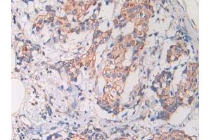 IHC-P analysis of Human Bile duct cancer Tissue, with DAB staining. (Cathelicidin antibody)