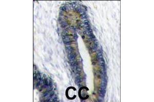 Formalin-fixed and paraffin-embedded human colon carcinoma reacted with FUBI Antibody , which was peroxidase-conjugated to the secondary antibody, followed by DAB staining. (FAU antibody  (AA 60-93))