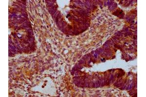 IHC image of ABIN7167248 diluted at 1:400 and staining in paraffin-embedded human ovarian cancer performed on a Leica BondTM system. (RAB21 antibody  (AA 141-222))