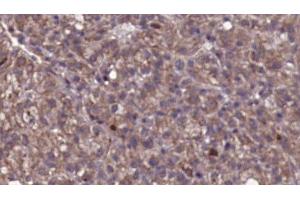 ABIN6276801 at 1/100 staining Human liver cancer tissue by IHC-P. (GRK2 antibody  (Internal Region))