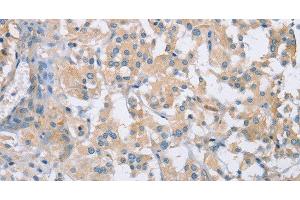 Immunohistochemistry of paraffin-embedded Human thyroid cancer using CDCP1 Polyclonal Antibody at dilution of 1:50 (CDCP1 antibody)