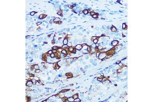 Immunohistochemistry of paraffin-embedded human esophageal cancer using Cytokeratin 5 (KRT5) (KRT5) Rabbit mAb (ABIN7268103) at dilution of 1:100 (40x lens). (Cytokeratin 5 antibody)