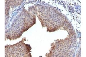 IHC testing of FFPE human bladder carcinoma and Cytokeratin 6 antibody. (Keratin 6 antibody  (C-Term))