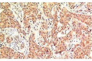 Immunohistochemistry of paraffin-embedded Human breast carcinoma tissue using ERK 1 Monoclonal Antibody at dilution of 1:200. (ERK1 antibody)