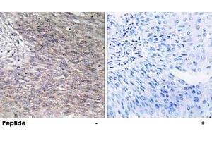 Immunohistochemistry analysis of paraffin-embedded human cervix carcinoma tissue using CHPF polyclonal antibody . (CHPF antibody)