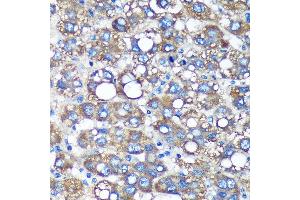 Immunohistochemistry of paraffin-embedded Human liver cancer using TIMMDC1 Rabbit pAb (ABIN7270929) at dilution of 1:100 (40x lens). (TIMMDC1 antibody  (AA 206-285))