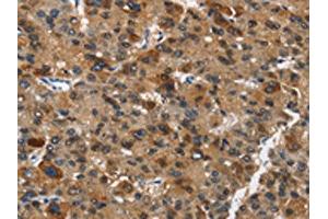 The image on the left is immunohistochemistry of paraffin-embedded Human liver cancer tissue using ABIN7190434(DCC Antibody) at dilution 1/70, on the right is treated with synthetic peptide.