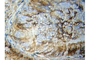 Immunohistochemistry of paraffin-embedded Breast cancer using STAT5B Antibody. (STAT5B antibody  (AA 40-280))