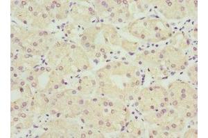 Immunohistochemistry of paraffin-embedded human gastric cancer using ABIN7149954 at dilution of 1:100 (FMO1 antibody  (AA 363-532))