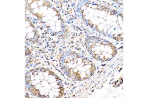 Immunohistochemistry of paraffin-embedded Human colon using MMP17 Rabbit pAb (ABIN3017219, ABIN3017220, ABIN3017221 and ABIN1680859) at dilution of 1:100 (40x lens). (MMP17 antibody)