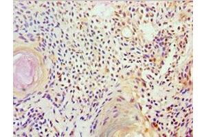 Immunohistochemistry of paraffin-embedded human breast cancer using ABIN7152570 at dilution of 1:100