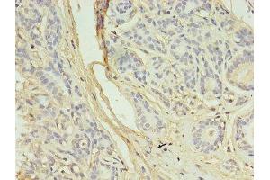 Immunohistochemistry of paraffin-embedded human breast cancer using ABIN7145079 at dilution of 1:100 (Aurora Kinase B antibody  (AA 1-255))