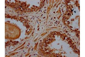 IHC image of ABIN7164923 diluted at 1:600 and staining in paraffin-embedded human prostate cancer performed on a Leica BondTM system. (PSME4 antibody  (AA 105-198))