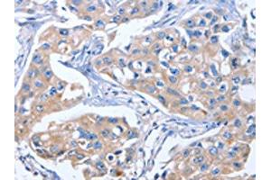 The image on the left is immunohistochemistry of paraffin-embedded Human breast cancer tissue using ABIN7191031(IBSP Antibody) at dilution 1/50, on the right is treated with synthetic peptide. (IBSP antibody)