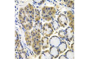 Immunohistochemistry of paraffin-embedded human colon carcinoma using APBB1 antibody (ABIN5971004) at dilution of 1/100 (40x lens). (FE65 antibody)
