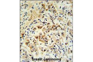 mouse BID Antibody (S61)IHC analysis in formalin fixed and paraffin embedded human breast carcinoma followed by peroxidase conjugation of the secondary antibody and DAB staining. (BID antibody  (AA 39-68))