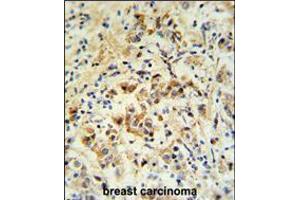mouse BID Antibody (S61)IHC analysis in formalin fixed and paraffin embedded human breast carcinoma followed by peroxidase conjugation of the secondary antibody and DAB staining.