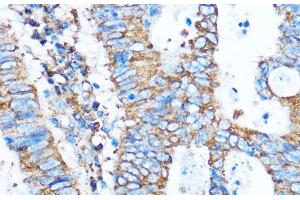 Immunohistochemistry of paraffin-embedded Human colon carcinoma using PIK3CA Polyclonal Antibody at dilution of 1:100 (40x lens). (PIK3CA antibody)