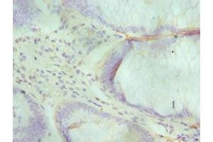 Immunohistochemistry of paraffin-embedded human colon cancer using ABIN7143716 at dilution of 1:100 (ALKBH1 antibody  (AA 110-389))
