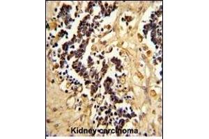 Formalin-fixed and paraffin-embedded human kidney carcinoma reacted with EHD3 Antibody (Center), which was peroxidase-conjugated to the secondary antibody, followed by DAB staining.