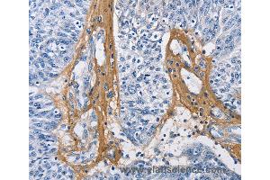 Immunohistochemistry of Human cervical cancer using COL3A1 Polyclonal Antibody at dilution of 1:60 (COL3A1 antibody)