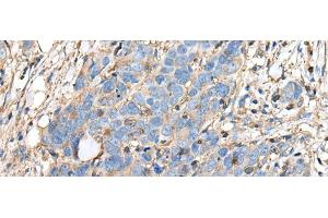 Immunohistochemistry of paraffin-embedded Human thyroid cancer tissue using PLA2G16 Polyclonal Antibody at dilution of 1:40(x200) (PLA2G16 antibody)