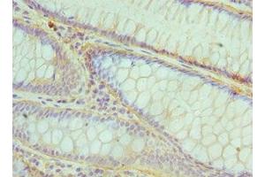 Immunohistochemistry of paraffin-embedded human colon cancer using ABIN7148567 at dilution of 1:100