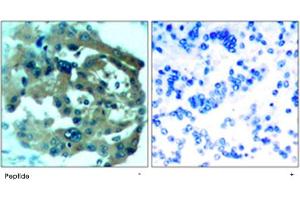 Immunohistochemical analysis of paraffin-embedded human lung carcinoma tissue using NF2 polyclonal antibody .