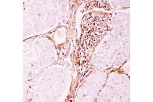 Immunohistochemical staining (Formalin-fixed paraffin-embedded sections) of human lung cancer tissue with ABCB1 polyclonal antibody  under 0. (ABCB1 antibody  (AA 621-650))