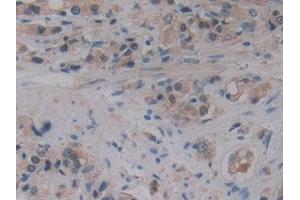 Detection of 15-LO-2 in Human Prostate cancer Tissue using Polyclonal Antibody to 15-Lipoxygenase-2 (15-LO-2)