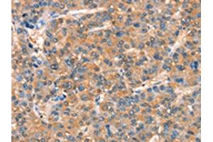 The image on the left is immunohistochemistry of paraffin-embedded Human liver cancer tissue using ABIN7189890(ARHGAP4 Antibody) at dilution 1/25, on the right is treated with synthetic peptide. (ARHGAP4 antibody)