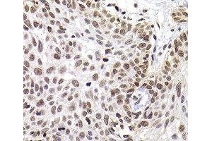 Immunohistochemistry of paraffin-embedded Human well-differentiated squamous skin carcinoma using PHIP Polyclonal Antibody at dilution of 1:100 (40x lens). (PHIP antibody)